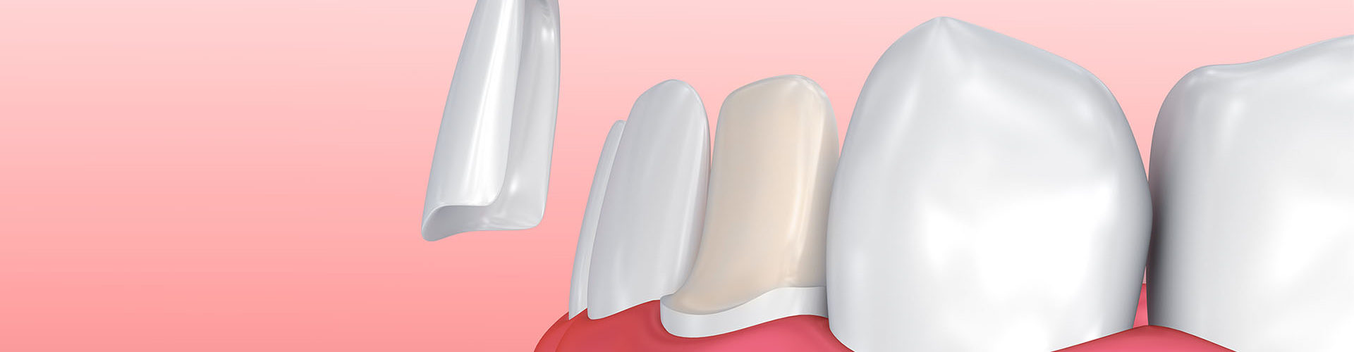 Dental porcelain veneers, Katy, TX Dental veneers, Katy, TX